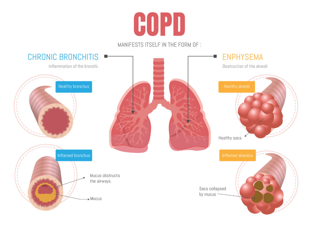 Living well with COPD: Chronic Bronchitis and Emphysema