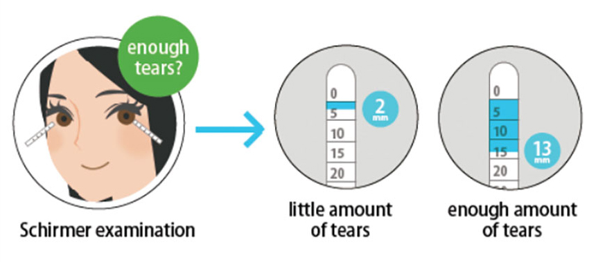 You may have to undergo a test to evaluate your tear production (Schirmer test)