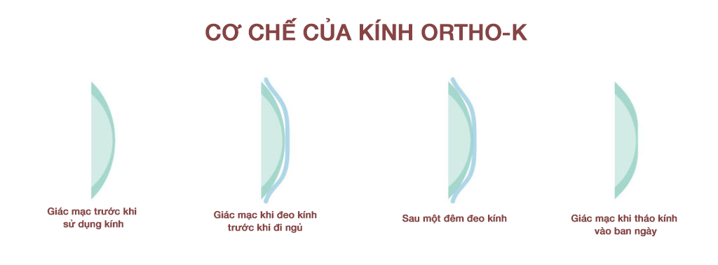 Prima Saigon: cơ chế của kính Ortho-K