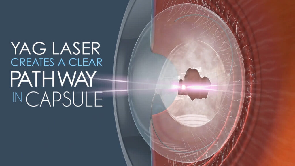 Bệnh nhân khi gặp hiện tượng đục bao sau thủy tinh thể sẽ được chỉ định sử dụng phương pháp Laser Yag để điều trị.