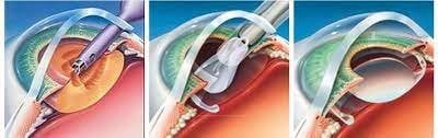 Cataract Surgery by Phaco