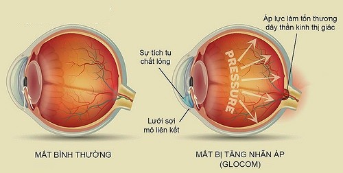 Trường hợp người bệnh có triệu chứng mất thị trường một phần tương ứng với nơi tổn thương trên lớp sợi thần kinh này, nhiều khả năng đã mắc glocom góc mở.