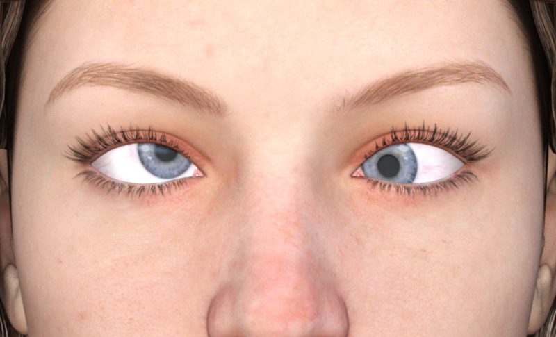 Bệnh lác mắt: những câu hỏi thường gặp