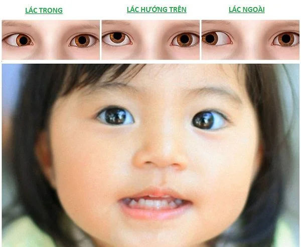 For children, the ability to regain vision is higher than that of older people and the level of recovery is best in children under 3 years old.