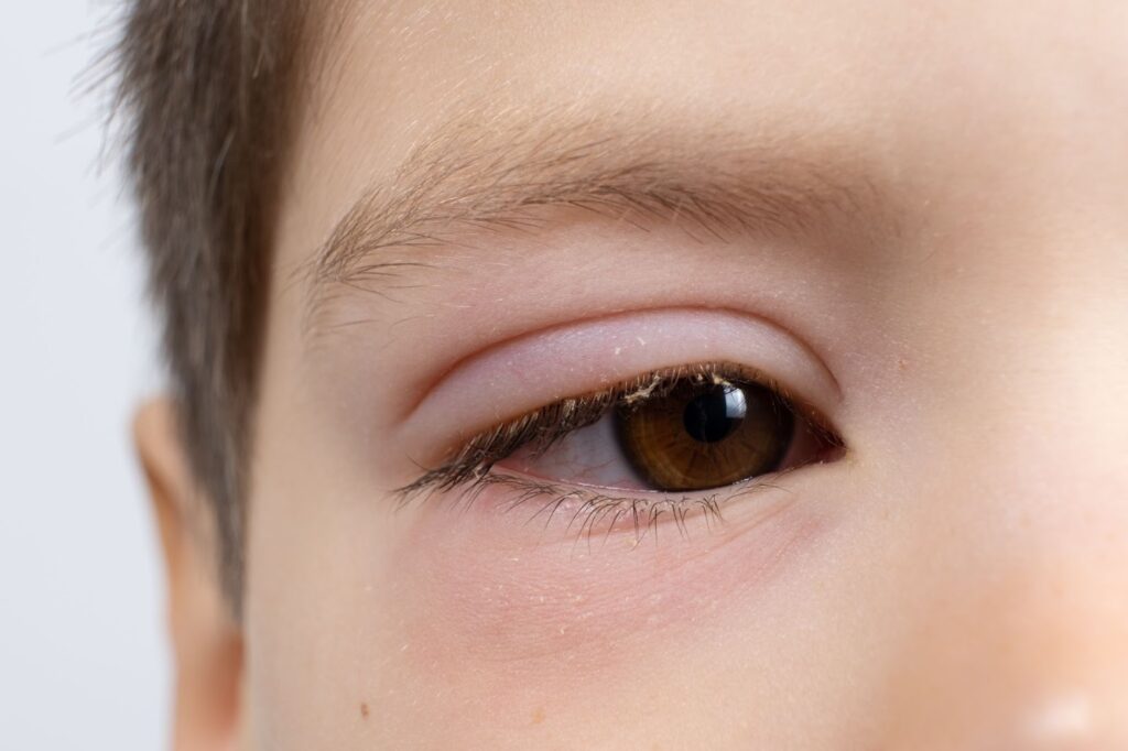 Mi mắt ngứa, sưng đỏ và đóng vảy là biểu hiện thường gặp ở bệnh viêm bờ mi