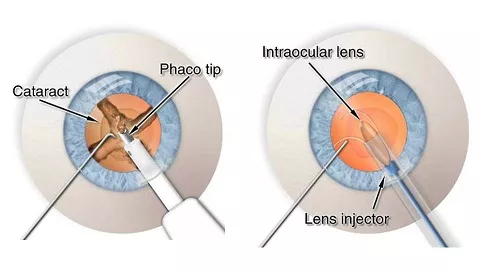 Cataract Method
