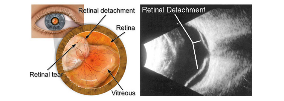 Retinal detachment: retinal examination and ultrasound imaging