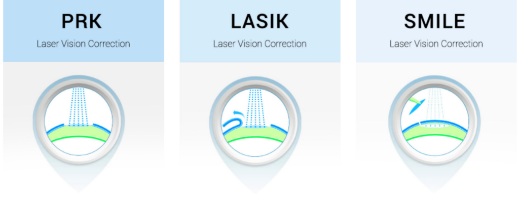 Ngoài ra còn có các loại ASA khác nhau như PRK, epi-LASIK, LASEK và TransPRK.