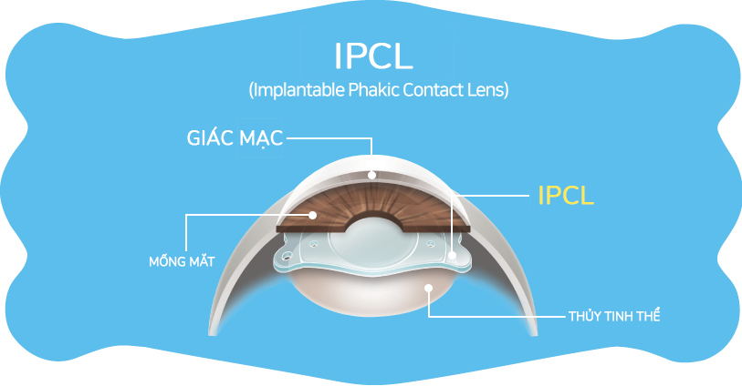 Phẫu thuật Phakic ICL là bước tiến vượt trội trong ngành nhãn khoa thế giới