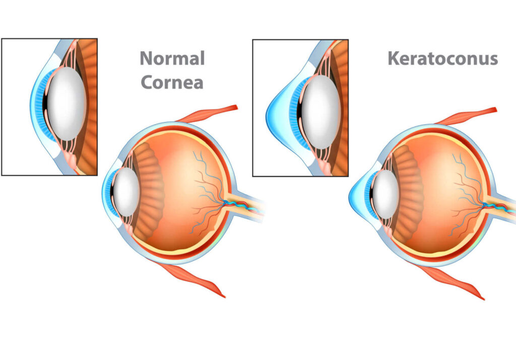 At Prima Saigon Eye Hospital, we use a variety of tests to diagnose and measure keratoconus for our patients