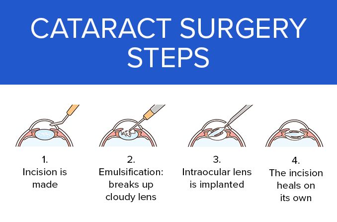 A Cataract Surgery
