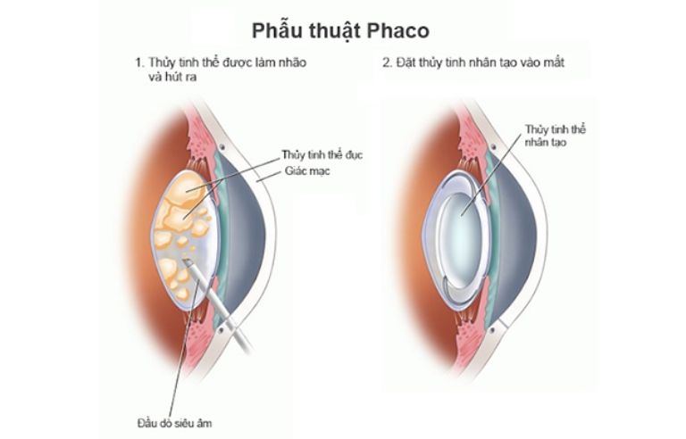 Prima Saigon: phẫu thuật Phaco