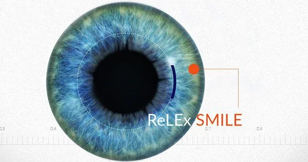 ReLEx SMILE, Công nghệ phẫu thuật khúc xạ hiện đại nhất hiện nay