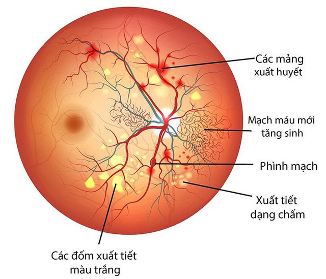 Bệnh viện Mắt Prima Saigon: hướng dẫn bệnh võng mạc đái tháo đường