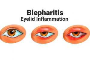 Blepharitis: That’s the medical term for “eyelid inflammation.”