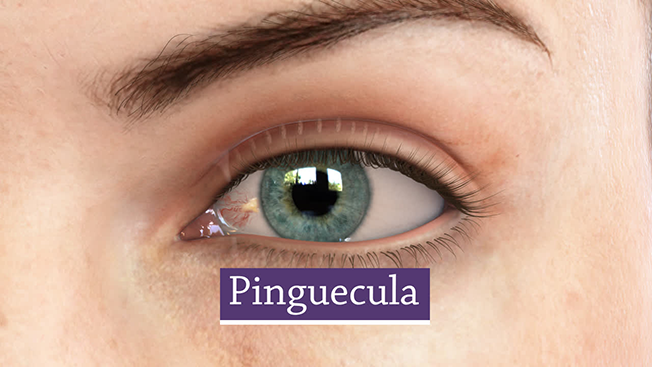 Prima Saigon Eye Hospital: Pinguecula and pterygium are growths on your eye’s conjunctiva, the clear covering over the white part of the eye.