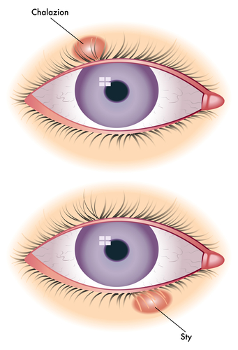 Differences between Stye and Chalazion