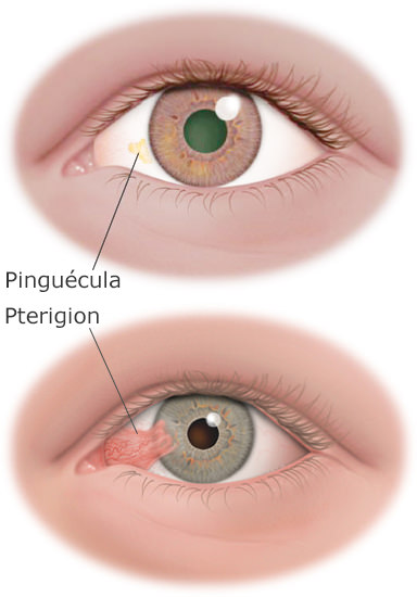 Prima Saigon Eye Hospital: Pinguecula and Pterygium