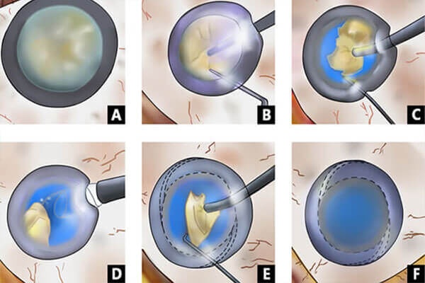 Bệnh viện Mắt Prima Sài Gòn: 9 bước trong phẫu thuật Phaco điều trị đục thủy tinh thể
