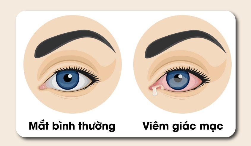 Bệnh viện Mắt Prima Sài Gòn: Viêm giác mạc có khi đi kèm với loét giác mạc còn được gọi là viêm loét giác mạc.