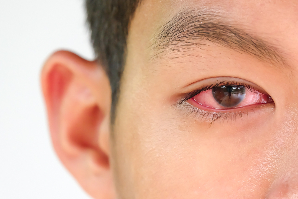 Prima Saigon Eye Hospital: Using contact lenses has many potential risks affecting vision