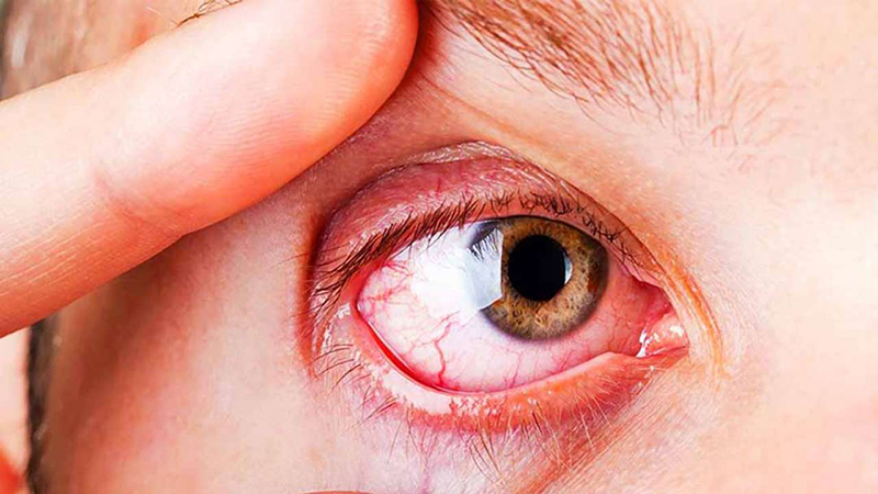 Bệnh viện Mắt Prima Sài Gòn: Người bệnh có thể gặp một số biến chứng sau phẫu thuật Glôcôm