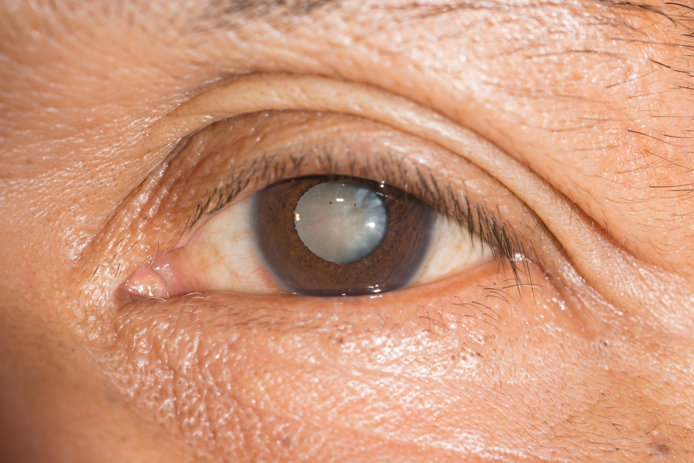 Prima Saigon Eye Hospital: Illustration of eyes with cataract