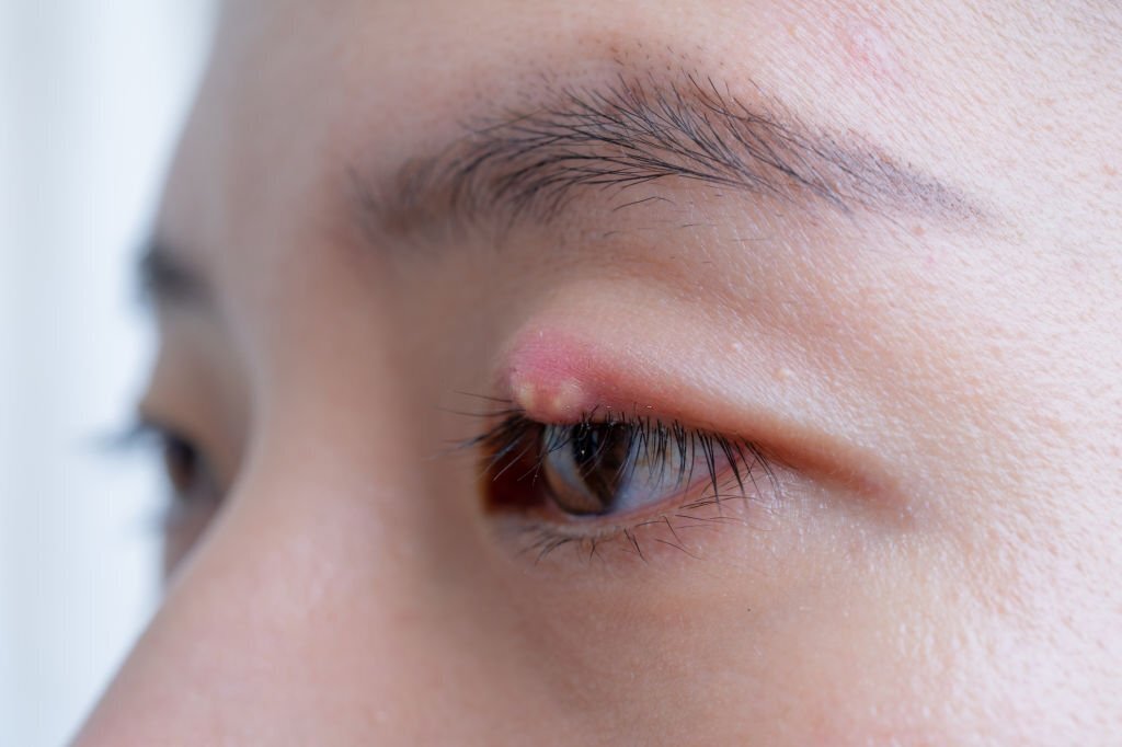 Bệnh viện Mắt Prima Sài Gòn: Nguyên nhân bệnh chắp mắt